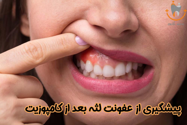 پیشگیری از عفونت لثه بعد از کامپوزیت