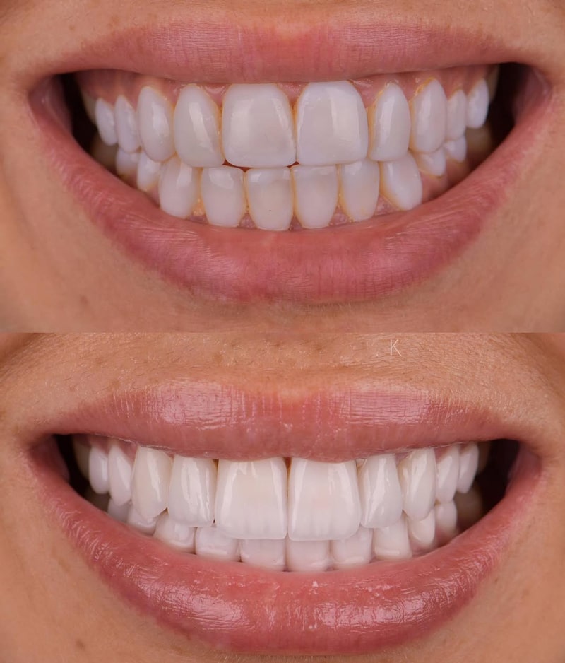 کامپوزیتم زرد شده چیکار کنم؟