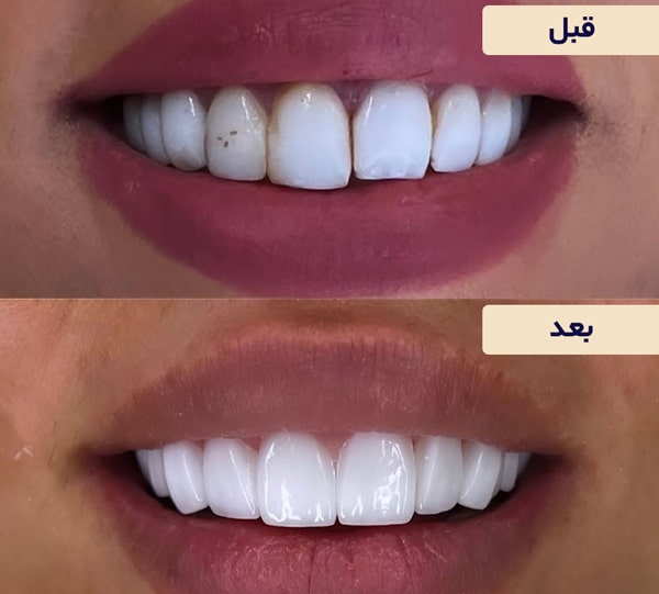 سفید کردن کامپوزیت دندان