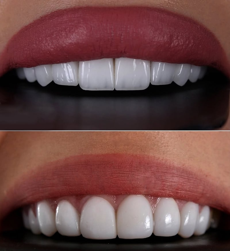 تعویض کامپوزیت قدیمی