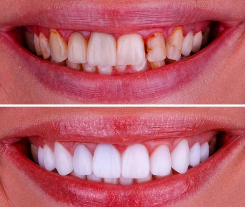 کامپوزیت دندان چیست