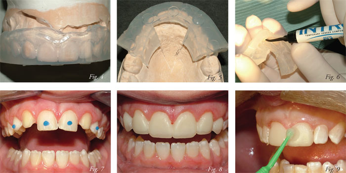 جای گذاری مواد کامپوزیت