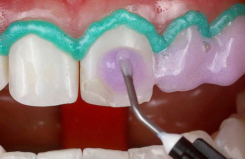 مراحل کامپوزیت دندان چگونه انجام می شود 
