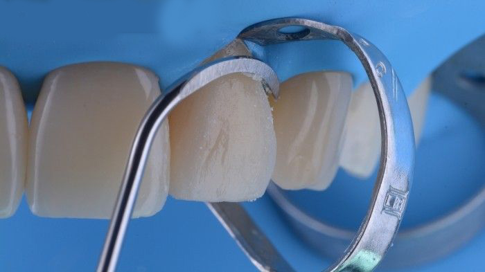 مرحله سفت شدن کامپوزیت