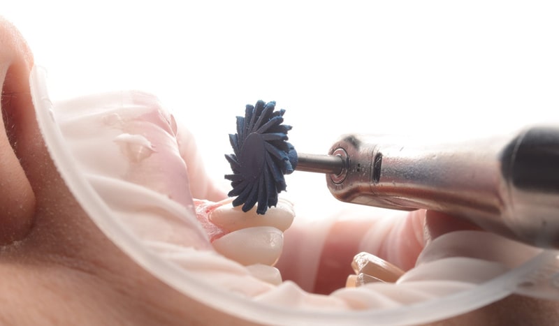 پولیش کامپوزیت دندان