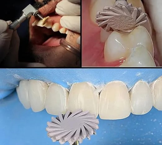 عکس قبل و بعد پولیش دندان کامپوزیت شده