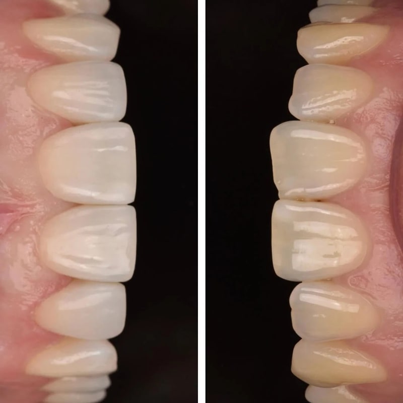 عکس قبل و بعد پولیش دندان