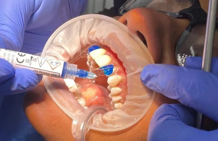 پالیش کامپوزیت دندان