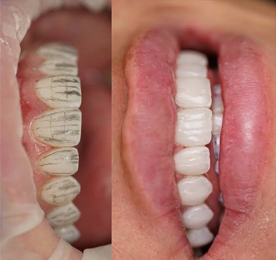 کامپوزیت دندان چگونه انجام می شود؟