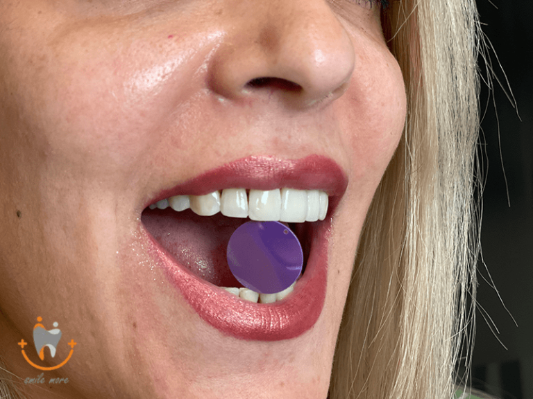 کامپوزیت در شرق تهران