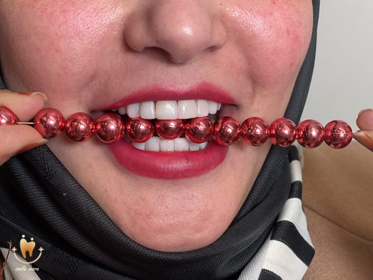 عکس کامپوزیت دندان