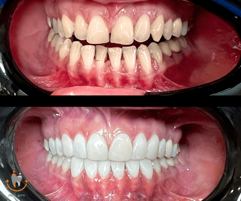 عکس قبل و بعد کامپوزیت دندان
