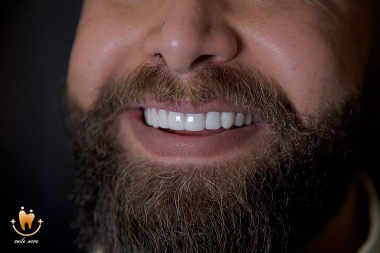 بهترین دکتر کامپوزیت دندان