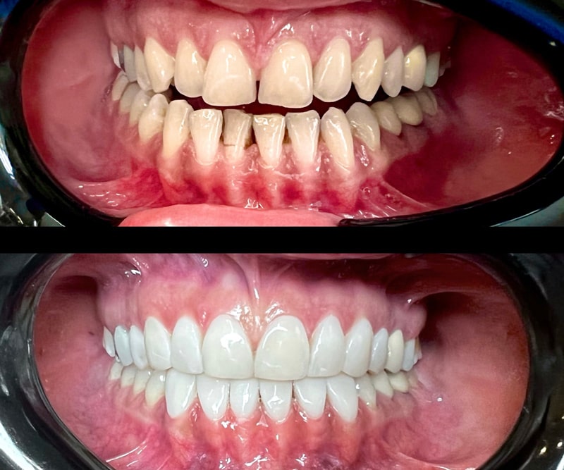 سفیدترین رنگ کامپوزیت ips