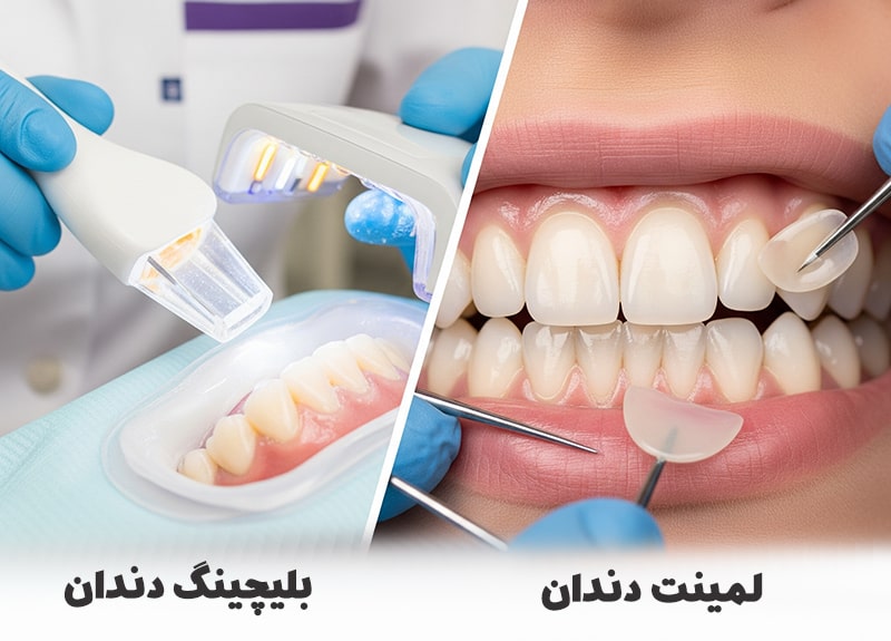 لمینت بهتر است یا بلیچینگ دندان