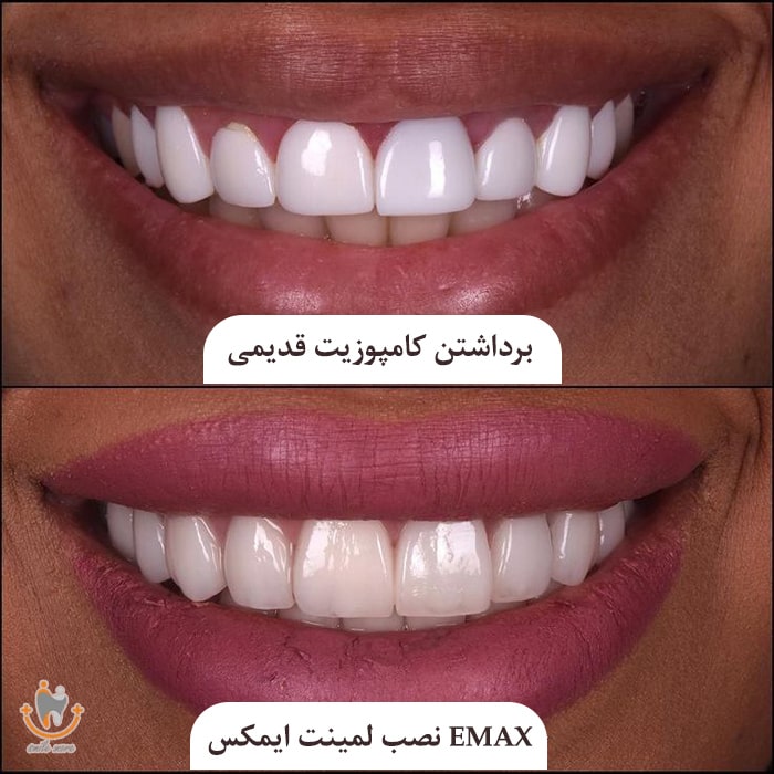 لمینت دندان Emax 