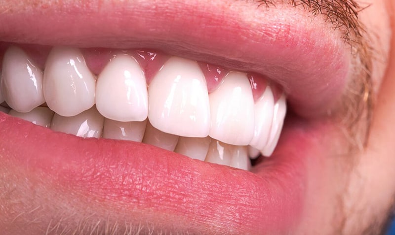 لمینت سرامیکی زیرکونیا