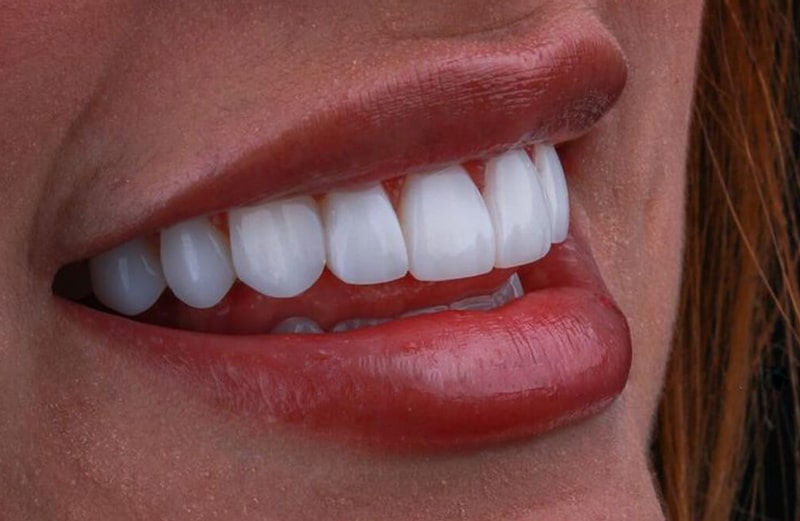 نمونه کار روکش زیرکونیا