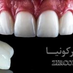 لمینت زیرکونیا