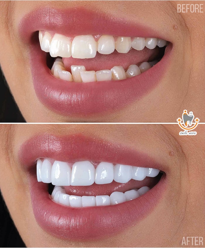 لمینت دندان زیرکونیا