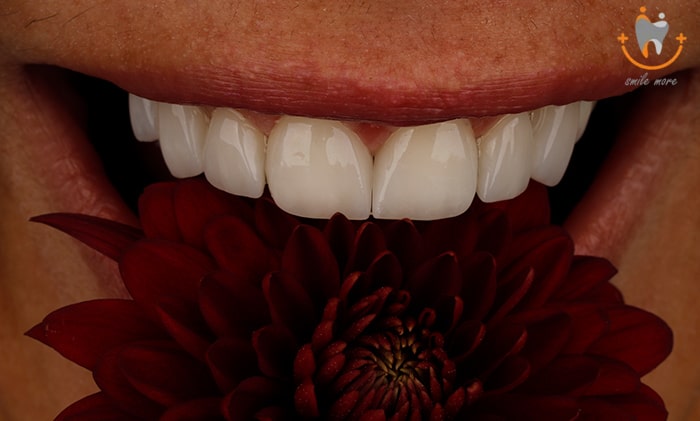 لیمنت دندان در تهران