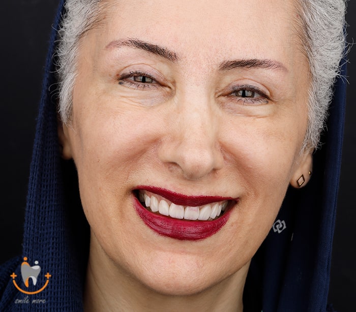 بهترین دکتر لمینت دندان در تهران