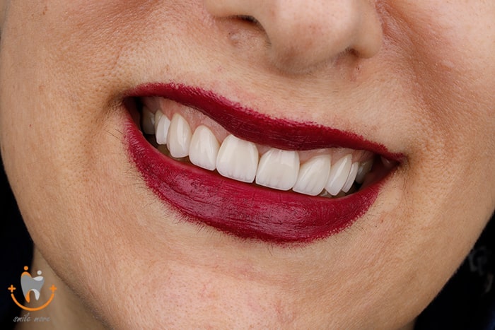 بهترین دکتر لمینت دندان در تهران