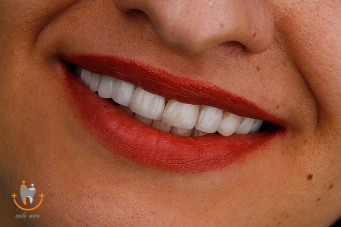 متخصص لمینت در تهران