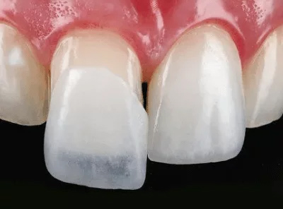 افتادن لمینت دندان 