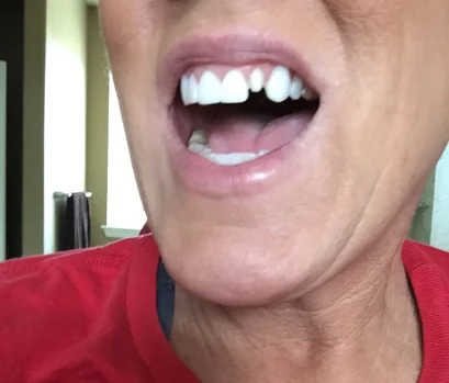 علت افتادن لمینت دندان