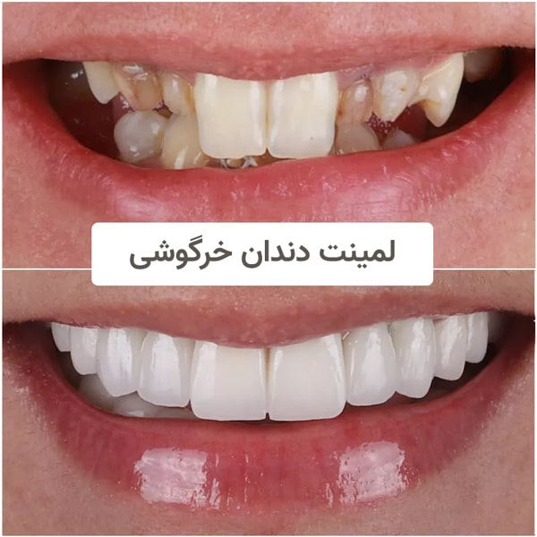 عکس دندان خرگوشی