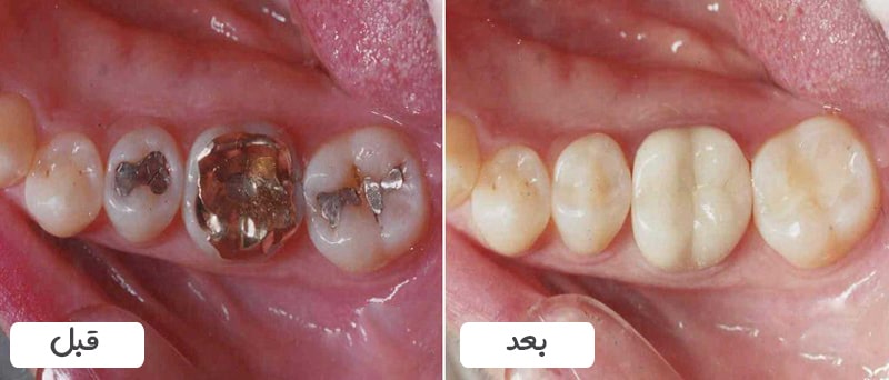 تفاوت آمالگام و کامپوزیت