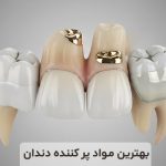 بهترین مواد پر کننده دندان