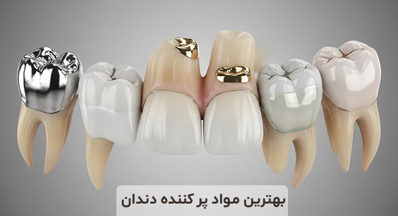 بهترین مواد پر کننده دندان
