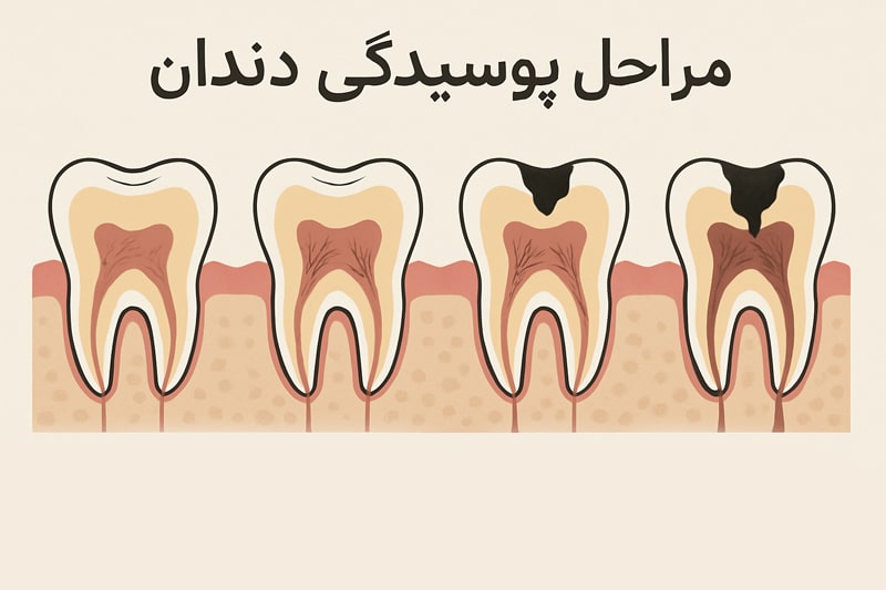 پوسیدگی دندان