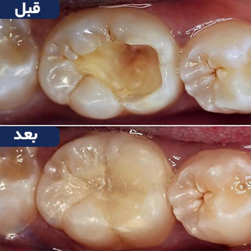 پر کردن دندان بعد از عصب کشی
