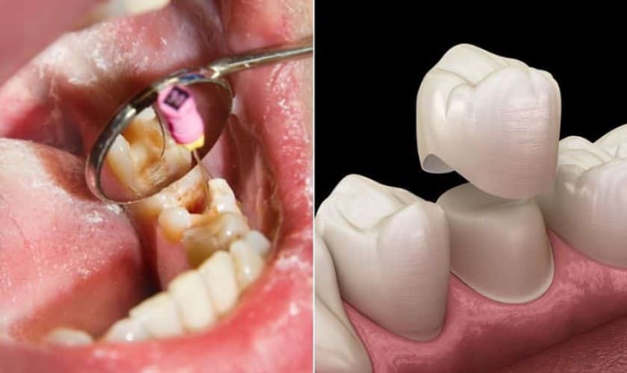 پس از عصب کشی، پر کردن دندان بهتر است یا روکش کردن؟