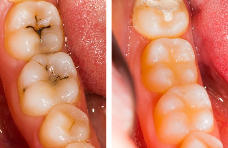 پر کردن دندان با کامپوزیت