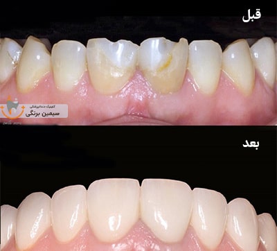 در صورت شکستن لمینت چه باید کرد؟