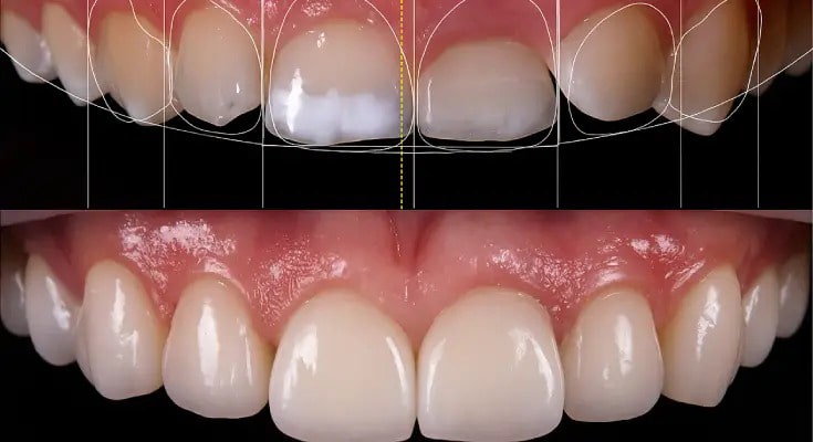 قیمت طرح لبخند