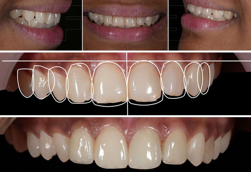 قیمت اصلاح طرح لبخند
