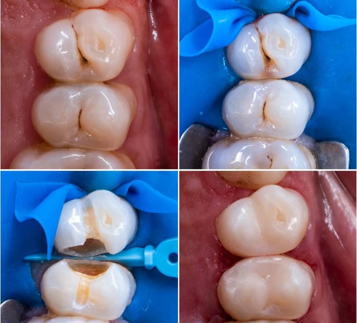 چند ساعت بعد از پر کردن دندان باید غذا خورد