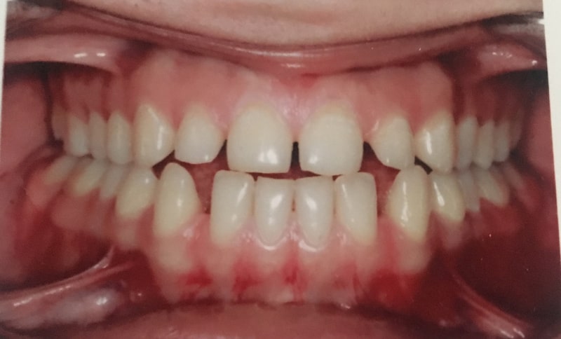 کامپوزیت دندان