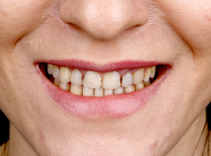 کامپوزیت دندان