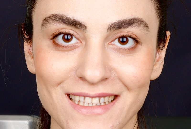 کامپوزیت دندان