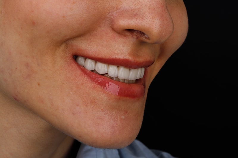 کامپوزیت دندان