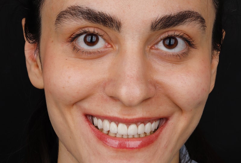 کامپوزیت دندان چیست