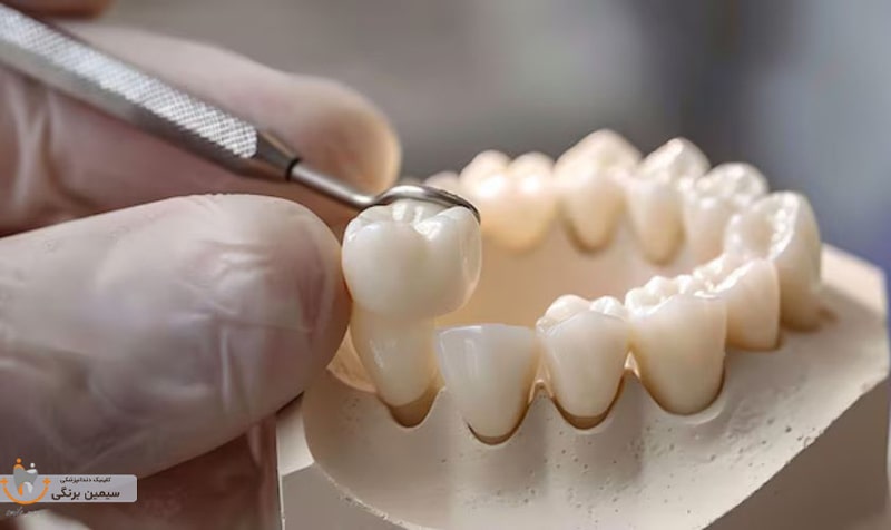 طول عمر روکش سرامیکی دندان چقدر است؟