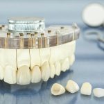 روکش دندان چقدر عمر می کند