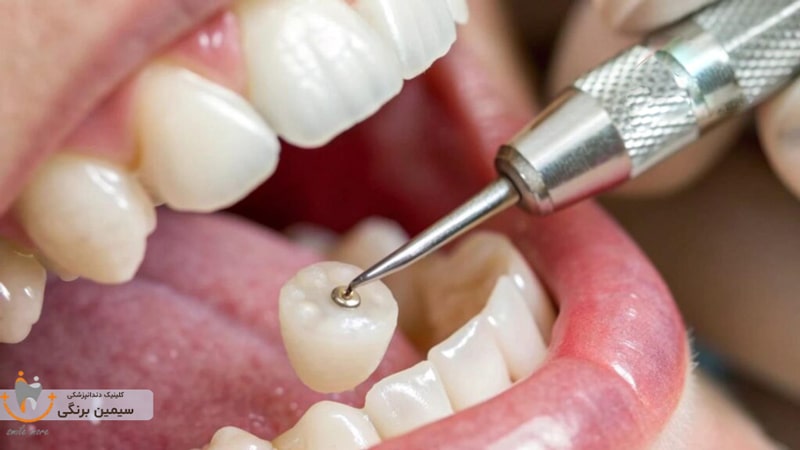 طول عمر روکش دندان